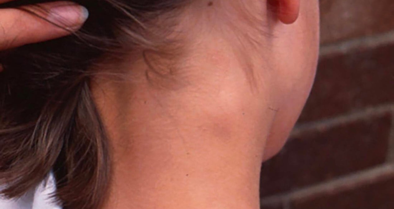 boyunda olusan sislikler ciddi hastalik belirtisi olabilir 89BVTkOe