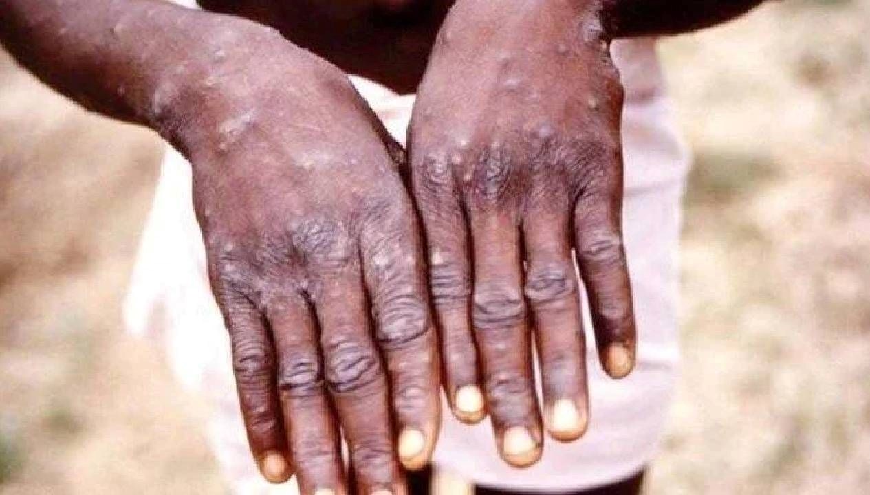 ganada m cicegi vaka sayisi 565e cikti 8U9hiB3U